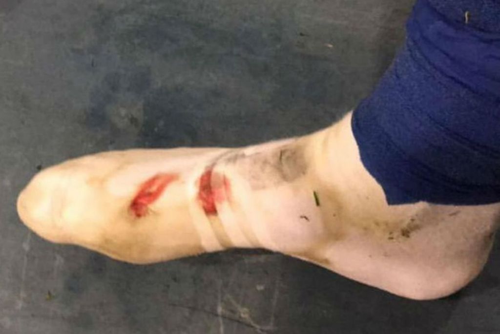 Stopalo Dine Perića (Foto: Instagram)