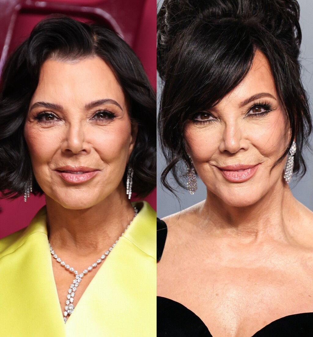 Kris Jenner prije i poslije facelifta (zatezanja lica)