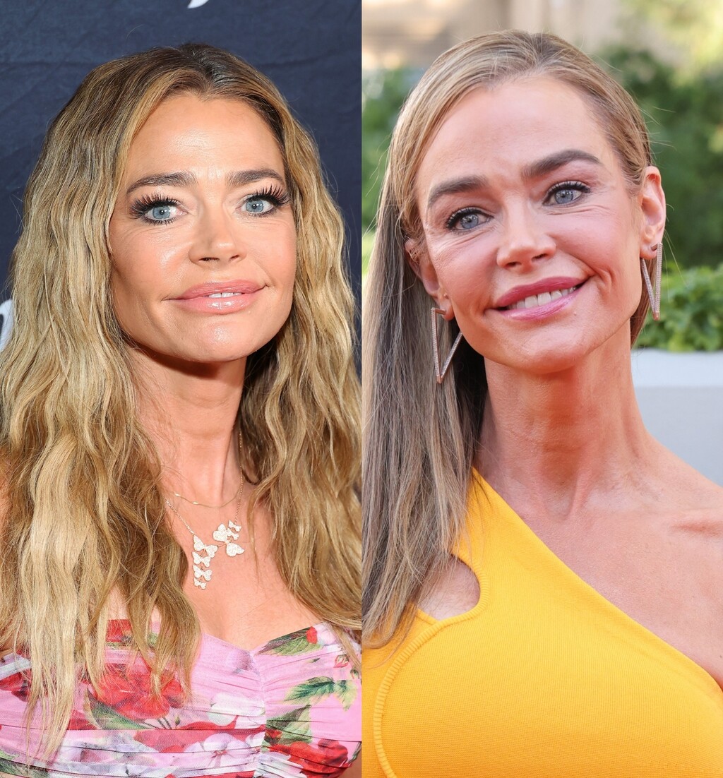 Denise Richards prije i poslije facelifta (zatezanja lica)