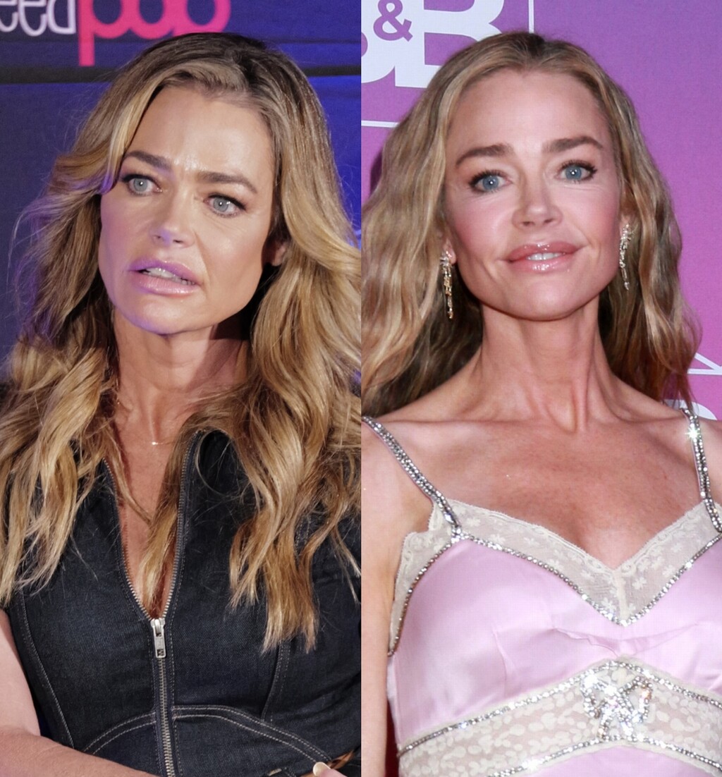 Denise Richards prije i poslije facelifta (zatezanja lica)