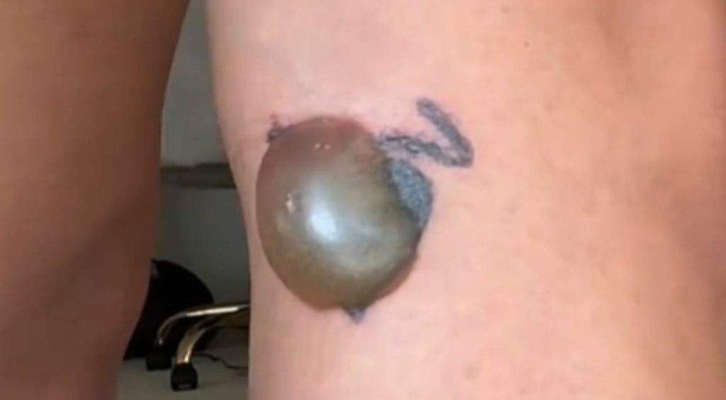 Influencerica Kyra Green i simptom uklanjanja tetovaže