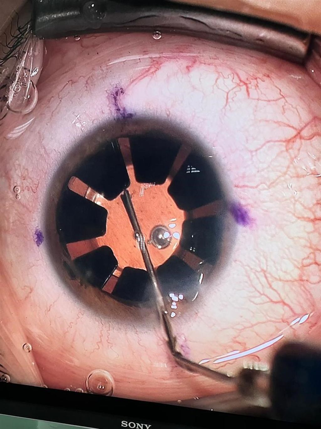 Implantacija umjetne šarenice u KBC Split