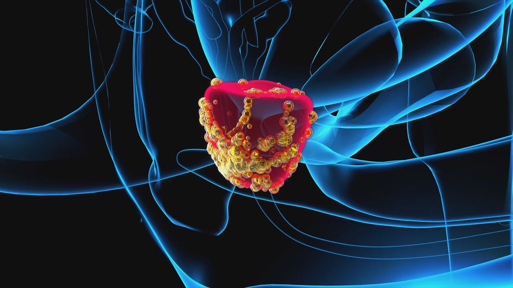 Pregled raka prostate - 3