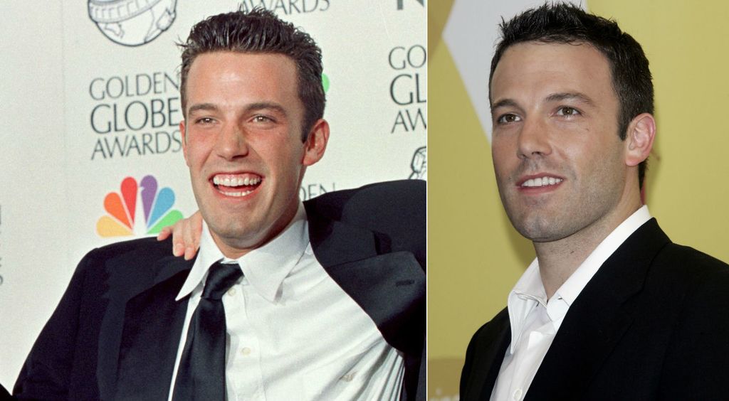 Ben Aflleck si je također priuštio nove zube