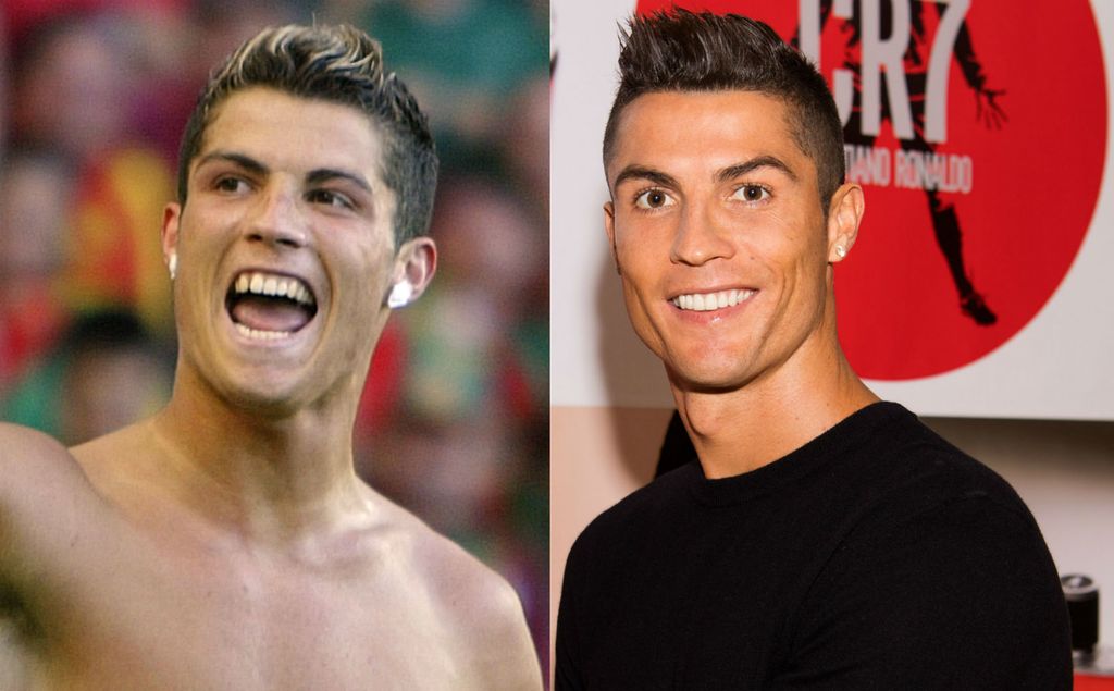 Cristiano Ronaldo prije i nakon što je sredio zube