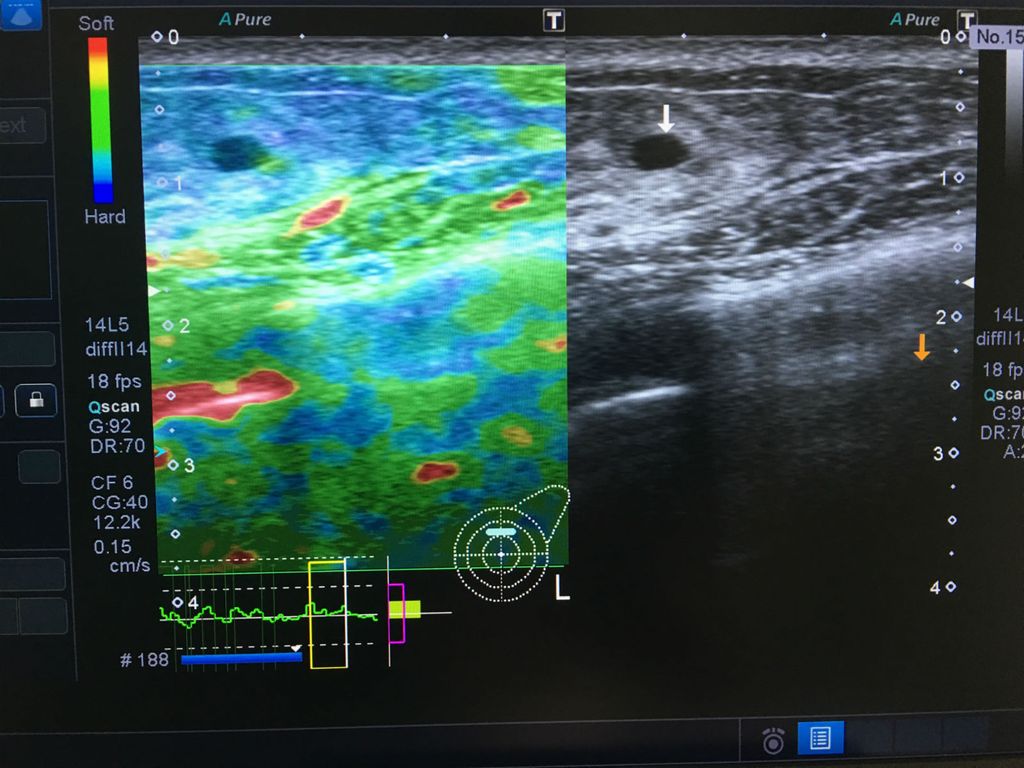 Strain elastografija