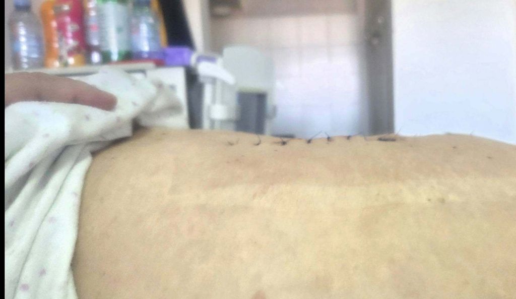 Odstranjen tumor težak 36 kilograma