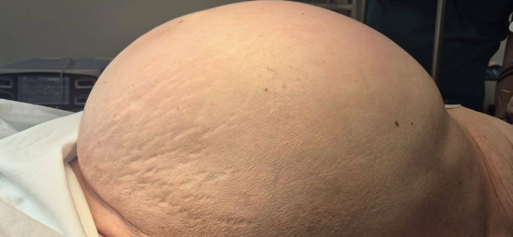 Odstranjen tumor težak 36 kilograma