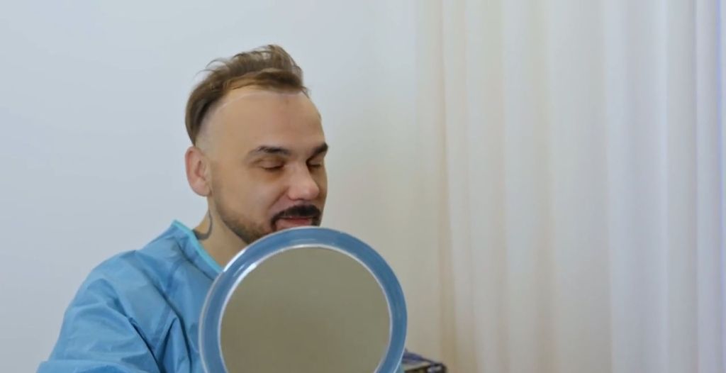 In Magazin: Presađivanje kose - 4