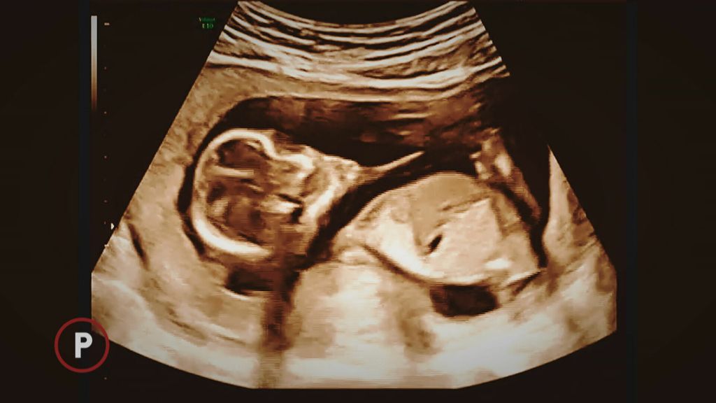 Prekid trudnoće - 6