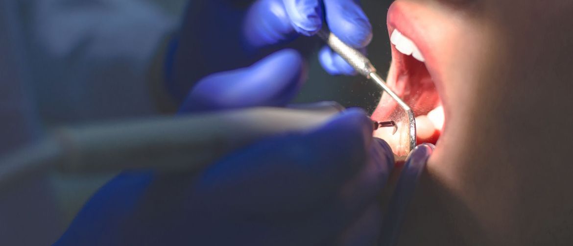Popravljanje zuba