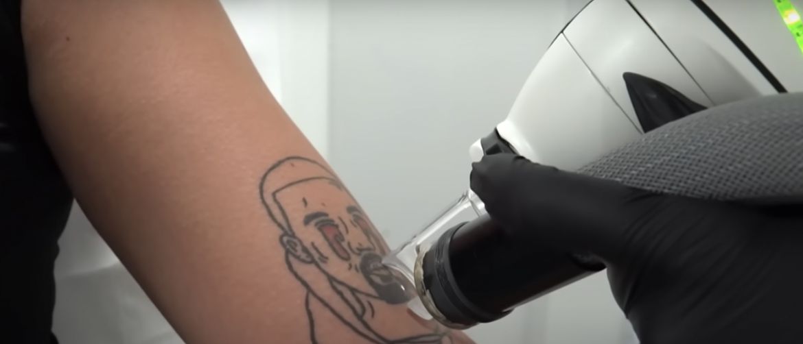 Uklanjanje tetovaži Kanye Westa