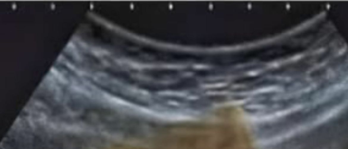 Snimka ultrazvuka sa sarmom u želucu