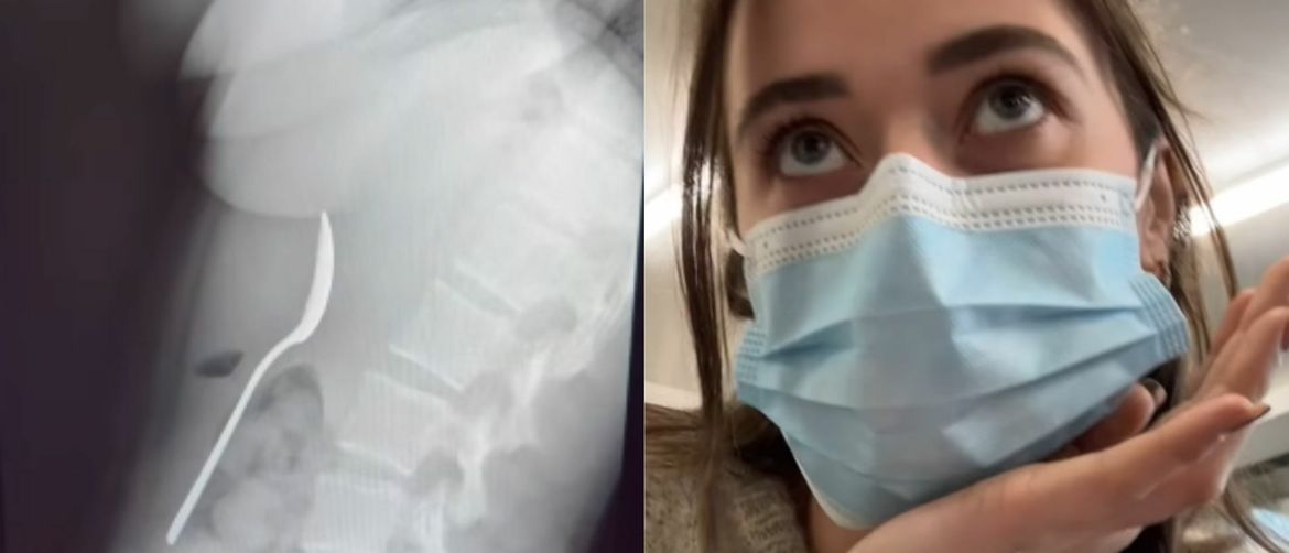 Belgijka sa žlicom u želucu