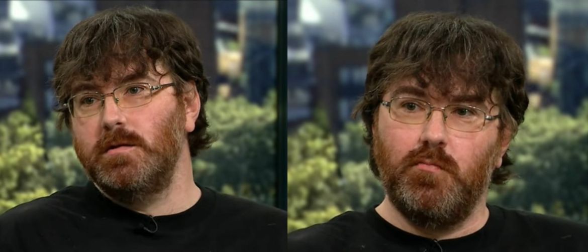 Amerikanac Michael Phillips kako razgovara o svom mikropenisu