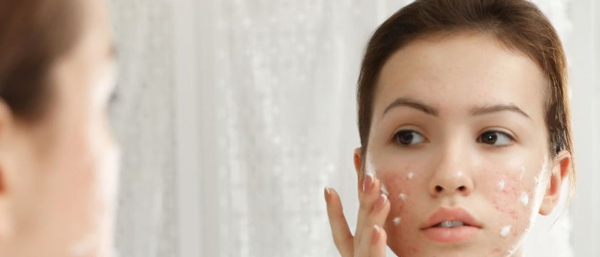 Tretiranje prištića zubnom pastom