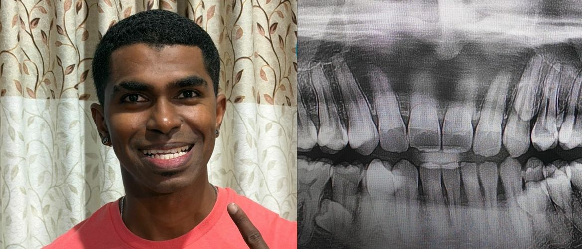 Muškarac iz Malezije Prathab Muniandy i njegovi rekordni zubi