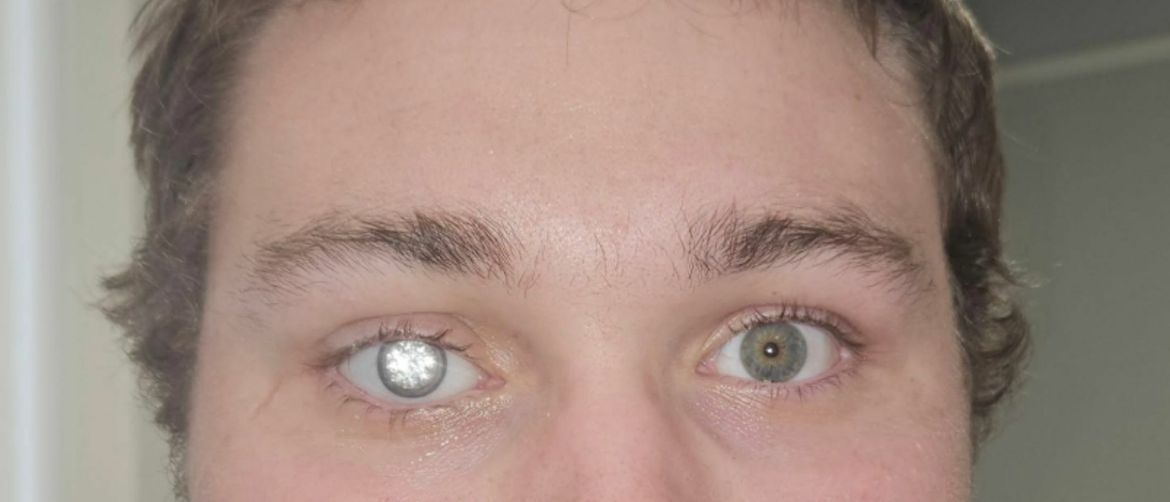 Slater Jones i njegovo proteza za oko s dijamantom