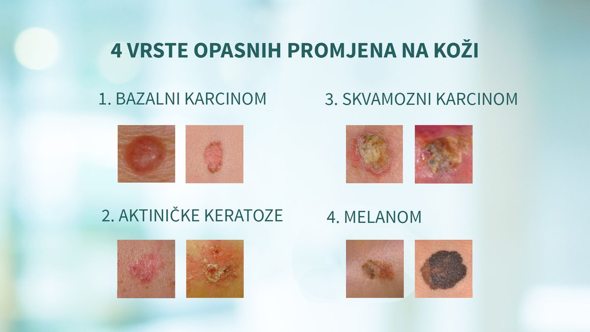 Četirir vrste opasnih promjena na koži