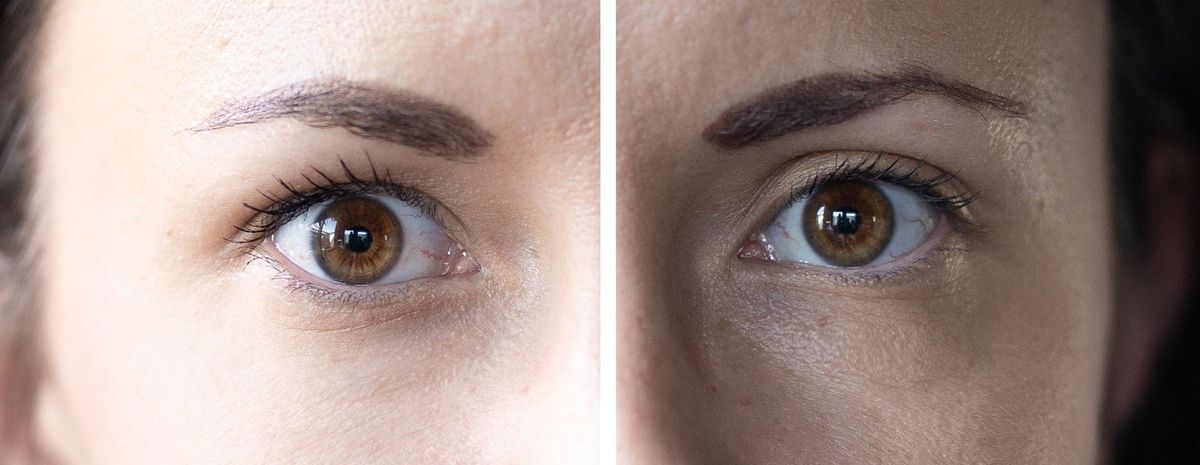 Testirale smo L'Oréal Paris Revitalift Laser kremu za instant-korekciju vrećica ispod očiju