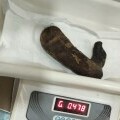 Kirurzi iz želuca 16-godišnjakinje odstranili klupko kose teško pola kilograma - 2