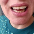 Mariji Laptalo na gastroskopiji oštetili zube