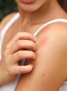 Ubod komarca jako svrbi i iritira