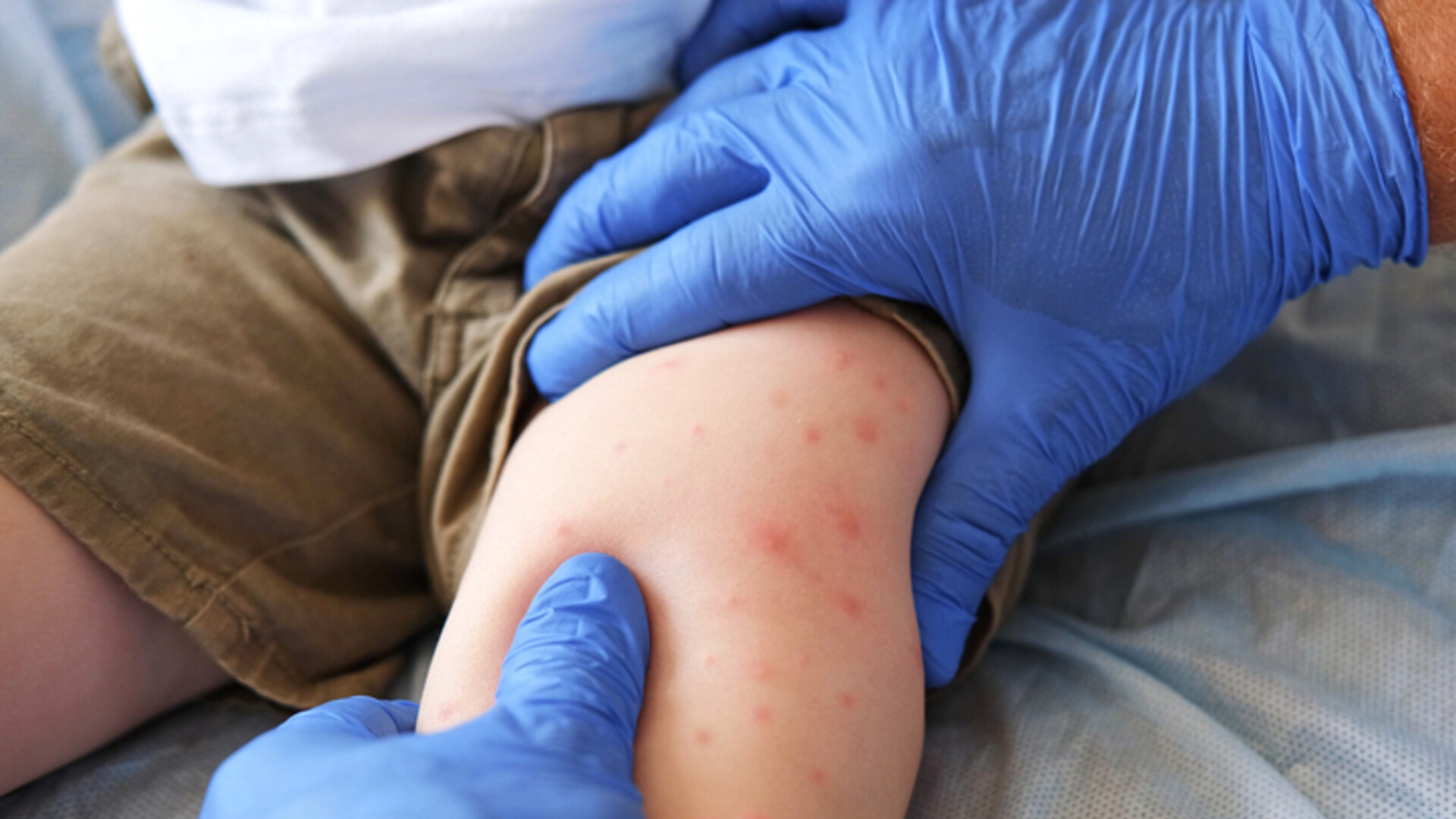 Bolest se vratila nakon 30 godina: "Epidemija u nedovoljno procijepljenim zajednicama"