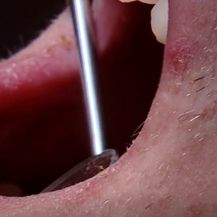 Pregled usne šupljine - 4