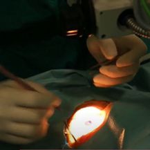 Prva transplantacija rožnice u KBC-u Split - 1