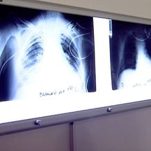 Bolja prevencija, manje oboljelih od raka (Foto: Dnevnik.hr) - 2