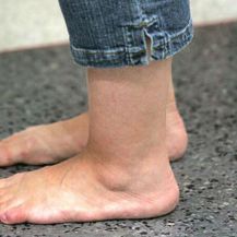 Natečena stopala (Foto: Getty Images)