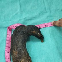 Kirurzi iz želuca 16-godišnjakinje odstranili klupko kose teško pola kilograma - 1