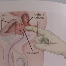 Prostata: Ilustracija - 2