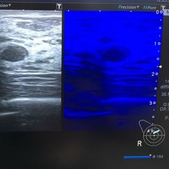 Micropure za uočavanje mikrokalcifikata