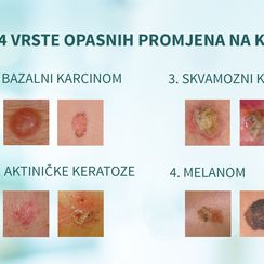 Četirir vrste opasnih promjena na koži