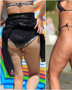 Celulit imaju i najljepše žene svijeta