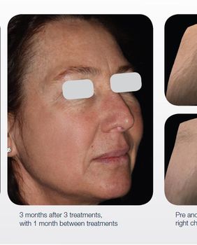 Prije i poslije tretmana laserom LUMENIS M22