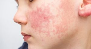 Peta bolest (parvovirus) kod djece: Ovaj čest virus širi se poput prehlade – evo kako ga prepoznati na vrijeme