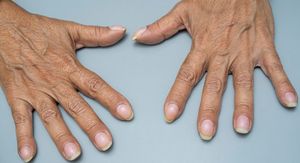 Batićasti prsti: Promjena na noktima koja može ukazivati na opasno stanje