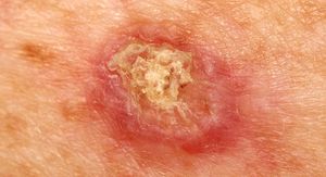 Planocelularni karcinom: Tihi rak koji počinje kao bezazlena ranica – prepoznajte ga na vrijeme