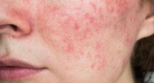 5 tretmana za rozaceu koje preporučuju dermatolozi