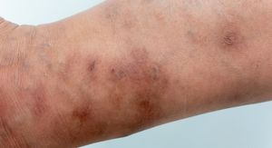 Svrab (šuga ili scabies): Možete ga imati, a da to ni ne znate – obratite pažnju na ove simptome