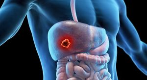 Tihi ubojica bez simptoma: 70 % slučajeva raka jetre prolazi neprimijećeno – evo kako ga AI sada otkriva
