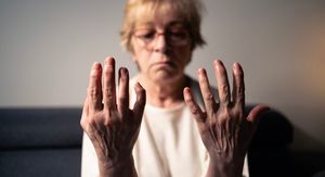 Imate lupus, artritis ili psorijazu? Ovo morate znati o riziku od raka