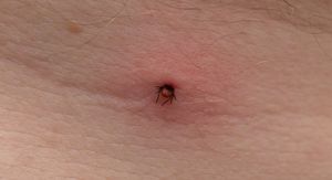 Bolesti od krpelja: Ovi simptomi znače da morate odmah liječniku