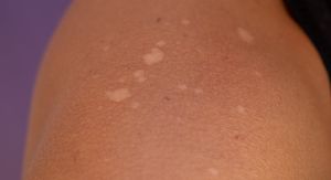 Bijele mrlje na koži: Znak bezazlenog problema ili ozbiljne bolesti?