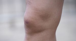 Prirodni lijek za vodu u koljenu: 5 jednostavnih obloga koji “ispuhuju” koljeno