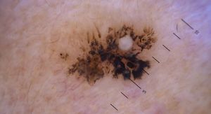 AI vs. dermatolozi: Tko bolje prepoznaje najopasniji rak kože? Rezultati bi vas mogli iznenaditi