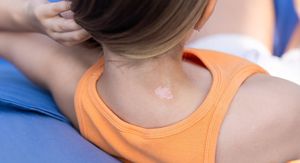 Bijele pjege od sunca: Zašto se pojavljuju, jesu li opasne i kako ih se riješiti?